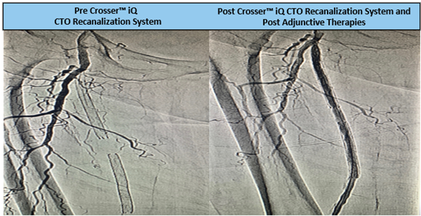 RobRighi's tweet photo. SFA w/ 10cm mid-moderately calcified CTO case. Dr. Cawich crossed using the #CrosseriQ catheter and observed a 1 min 32 sec activation time to cross. #CrossThisFast
For use in peripheral artery CTOs; Not for use in carotid arteries. Safety info: https://t.co/JP4ablgw5Q https://t.co/dQoLZhSX5D