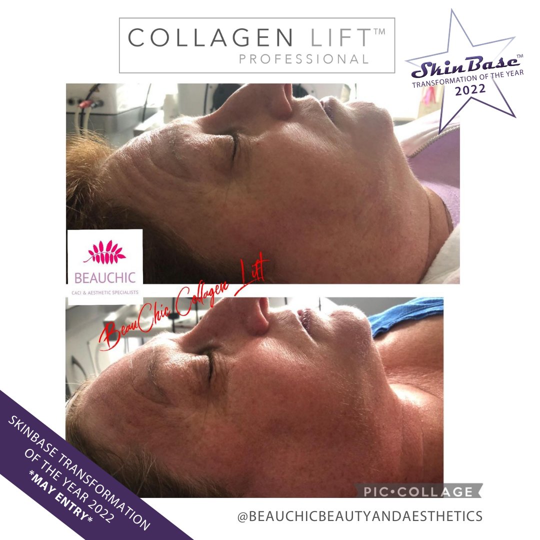 SkinBase_facial's tweet image. ⭐️ May transformation with this fabulous entry from Beau Chic Aesthetics &amp;amp; Skincare. These fantastic results were achieved through a 6 treatment course of Collagen Lift.  

Click the link in our bio for your chance to Win a Holiday! #skinbase #collagenlift #transformation22