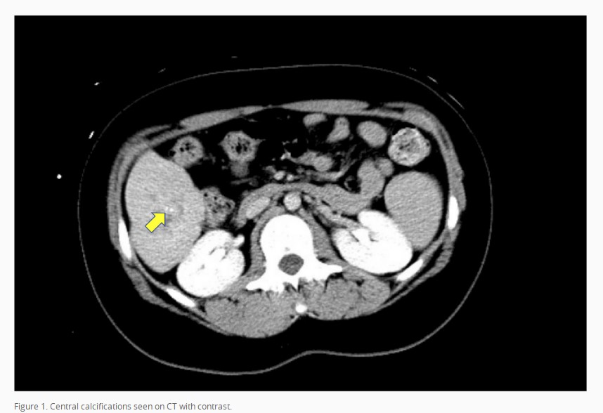 HepatomaRes's tweet photo. #FHCC #HCC #livertwitter #MedTwitter #GITwitter #HCCTwitter #meded
📢Glad to share an article on "A focused review on recent advances in diagnosis and management of fibrolamellar hepatocellular carcinoma" from Dr. Mahmoud Aryan's team.
🔗PDF version: https://t.co/cKFXxhDT5n https://t.co/ca4yD9jpEw