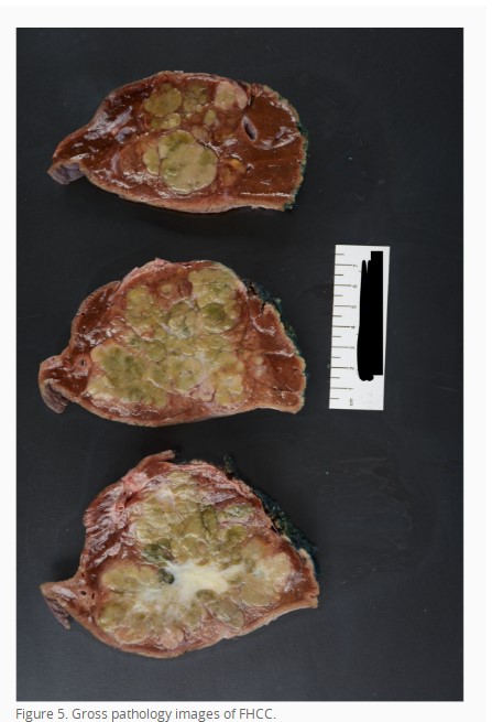 HepatomaRes's tweet photo. #FHCC #HCC #livertwitter #MedTwitter #GITwitter #HCCTwitter #meded
📢Glad to share an article on "A focused review on recent advances in diagnosis and management of fibrolamellar hepatocellular carcinoma" from Dr. Mahmoud Aryan's team.
🔗PDF version: https://t.co/cKFXxhDT5n https://t.co/ca4yD9jpEw