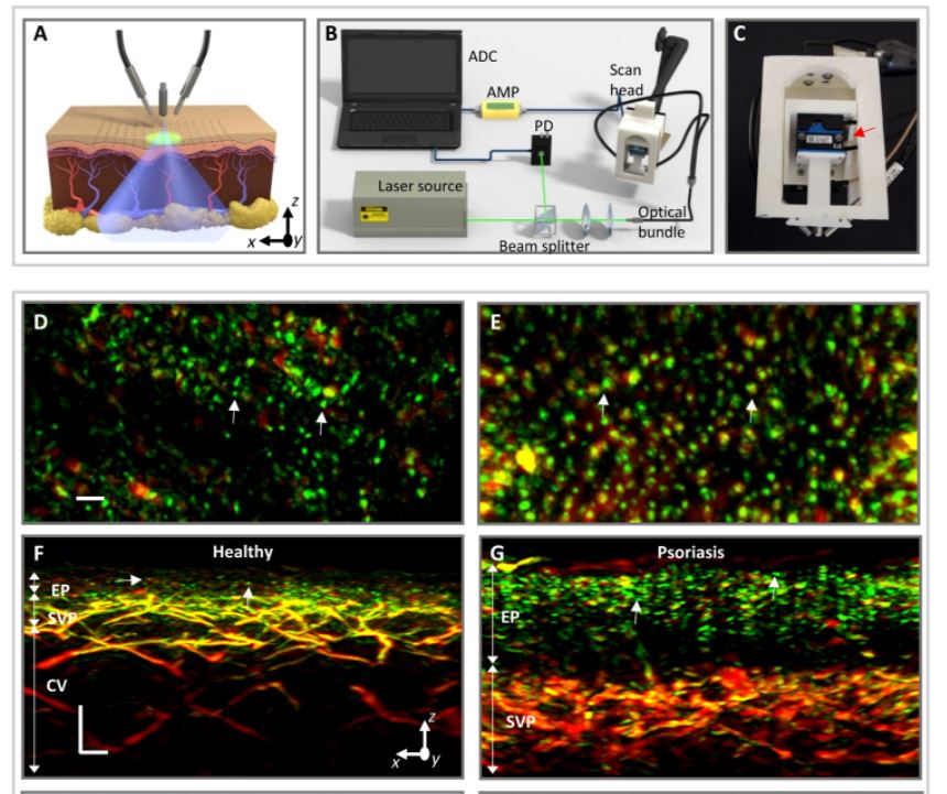 Enabling precision #monitoring  of #psoriasis  treatment by optoacoustic mesoscopy
@ScienceTM @Inno_Medicine 
#imaging #biotech #technology #biology #MedTwitter #health #medicine #research #MedEd #machine 
tweets by @huitongruan 
doi.org/10.1126/scitra…