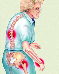 Osteoamigos's tweet photo. La Organización Mundial de la Salud (OMS)  considera a la #osteoporosis como una de las epidemias de este siglo. La #Osteoporosis reduce  la densidad y la calidad de los #huesos convirtiendo nuestro esqueleto en una estructura cada vez más frágil y porosa. Consulta con tu médico https://t.co/XXfvBKLT6E