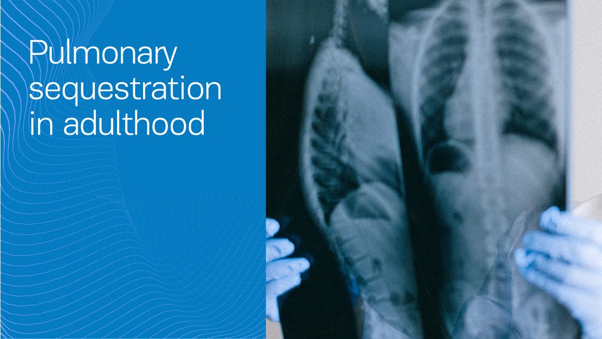 PneumonJ's tweet photo. #pulmonarysequestration is a rare congenital malformation with an incidence of 0.1%, representing 0.15–6.4% of all #pulmonarymalformations with 10% manifesting in adulthood.
👉At @PneumonJ By Ribeiro et al. | DOI:https://t.co/HQ5S1OZp29 https://t.co/QH2jZz83TI
