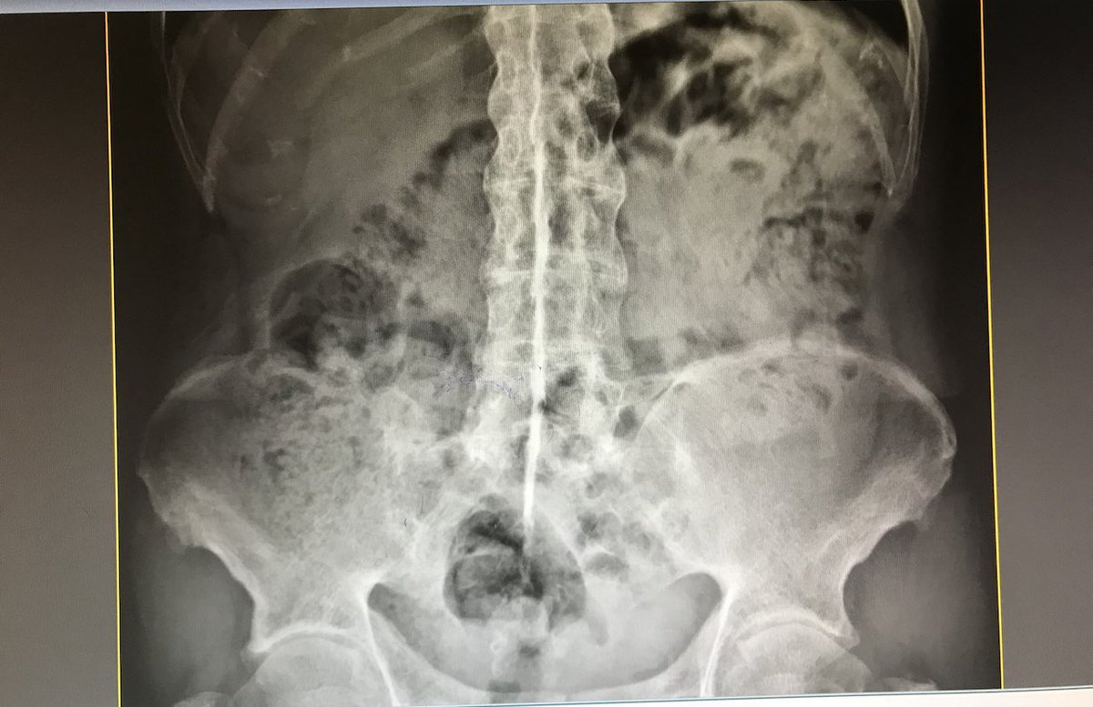 Alegalindom's tweet photo. Osificación del ligamento interespinoso “signo de la daga”, paciente con espondilitis anquilosante #reumatip https://t.co/1EMCfvlDKr