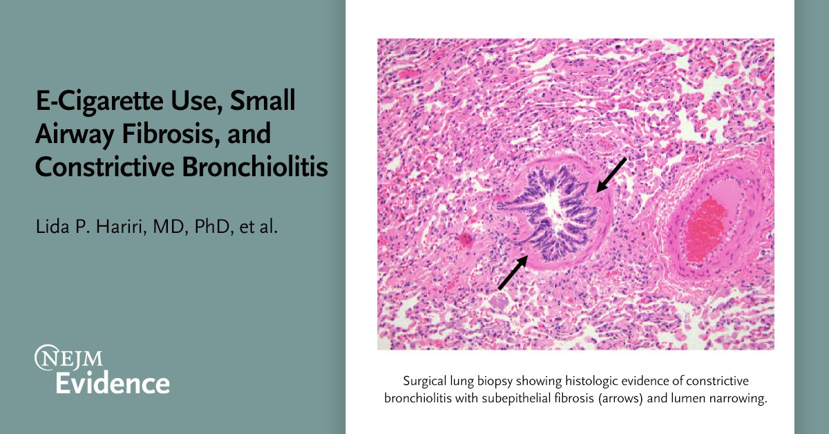 In this series, <a href="/LidaHariri/">Lida Hariri</a> et al. associate the histopathologic pattern of small airway-centered fibrosis, including constrictive bronchiolitis, with vaping; potentially defining a clinical and pathologic entity associated with #ecigarette use. eviden.cc/3stnh1y