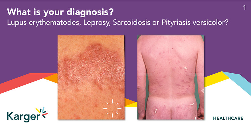 HealthKarger's tweet photo. Welcome #dermatologists 👩⚕️👨⚕️ to quiz 1 in the 2nd round of our #DermaQuiz ❓ Look closely and write us your answer in the comments. The correct answer will be here next Monday.
Thanks again to @max_tischler and https://t.co/mbrJsQvKF1 for the support 🤩
#KargerHCP https://t.co/Y7JFnTDK5g