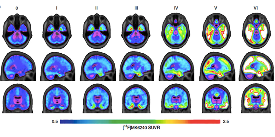 Alzforum (@alzforum) on Twitter photo Tau-PET allows scientists to use what was once a postmortem staging scheme in living people. Braak stage correlated with other AD imaging and fluid markers. <a href="/mcgillu/">McGill University</a> ow.ly/YnKK50J0ysH Tau-PET allows scientists to use what was once a postmortem staging scheme in living people. Braak stage correlated with other AD imaging and fluid markers. <a href="/mcgillu/">McGill University</a> ow.ly/YnKK50J0ysH