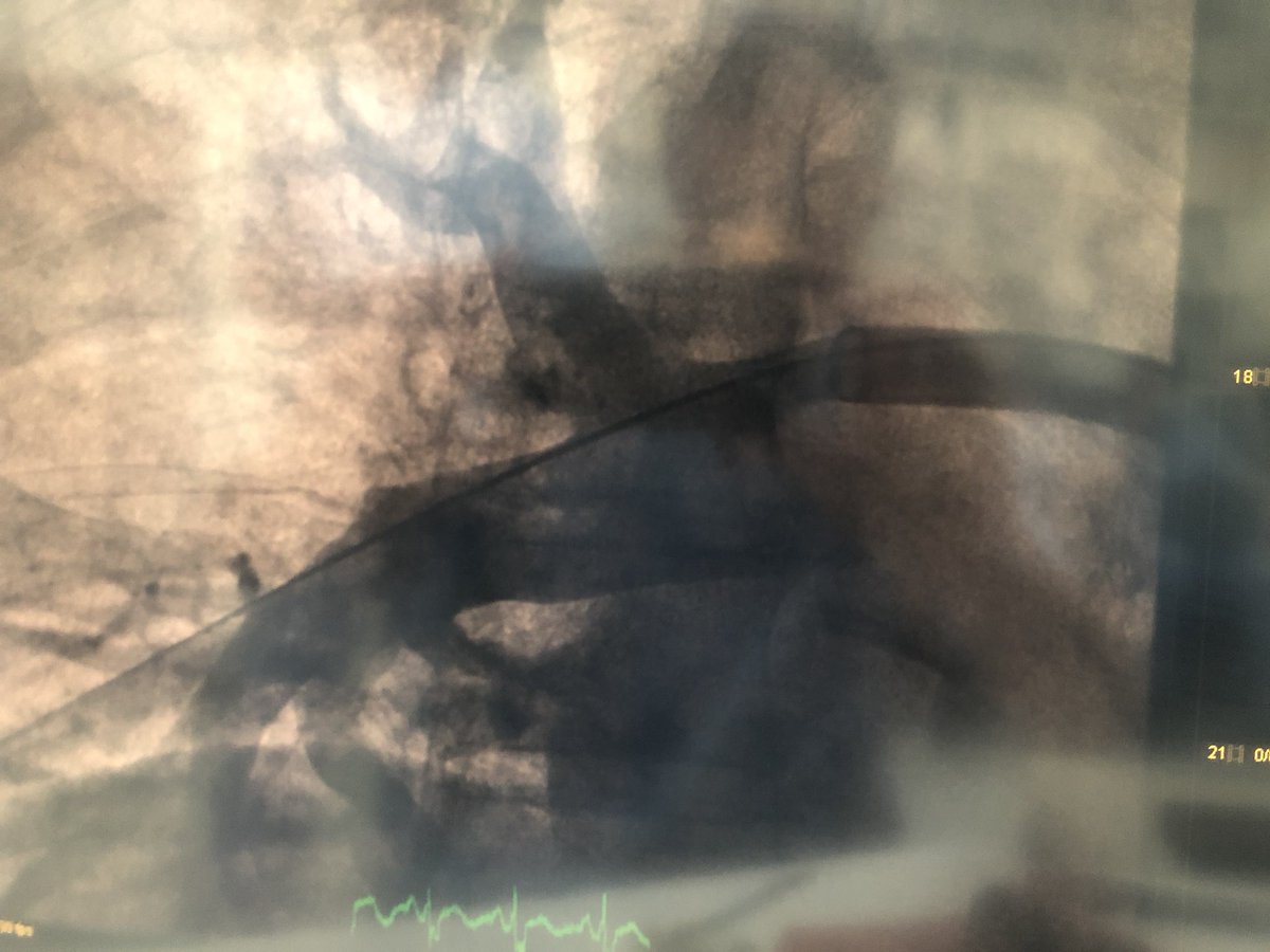 Silvio_N_Leal's tweet photo. First Portuguese use of Flowtriever device in acute pulmonary embolism Great aspirative power, very impressive result.
@Hospital de Santa Cruz, Lisbon
@InariMedical https://t.co/TM6UroEeUp