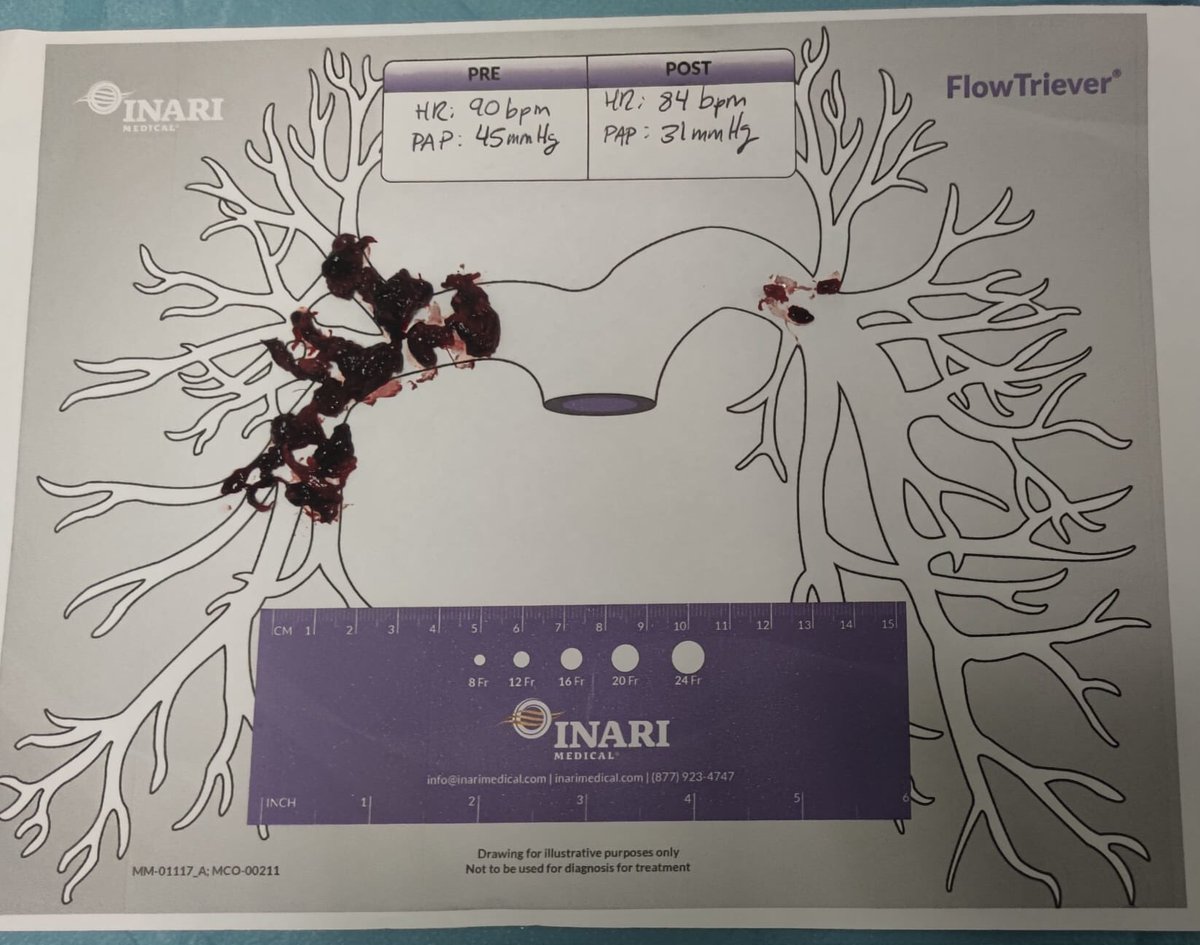 Silvio_N_Leal's tweet photo. First Portuguese use of Flowtriever device in acute pulmonary embolism Great aspirative power, very impressive result.
@Hospital de Santa Cruz, Lisbon
@InariMedical https://t.co/TM6UroEeUp
