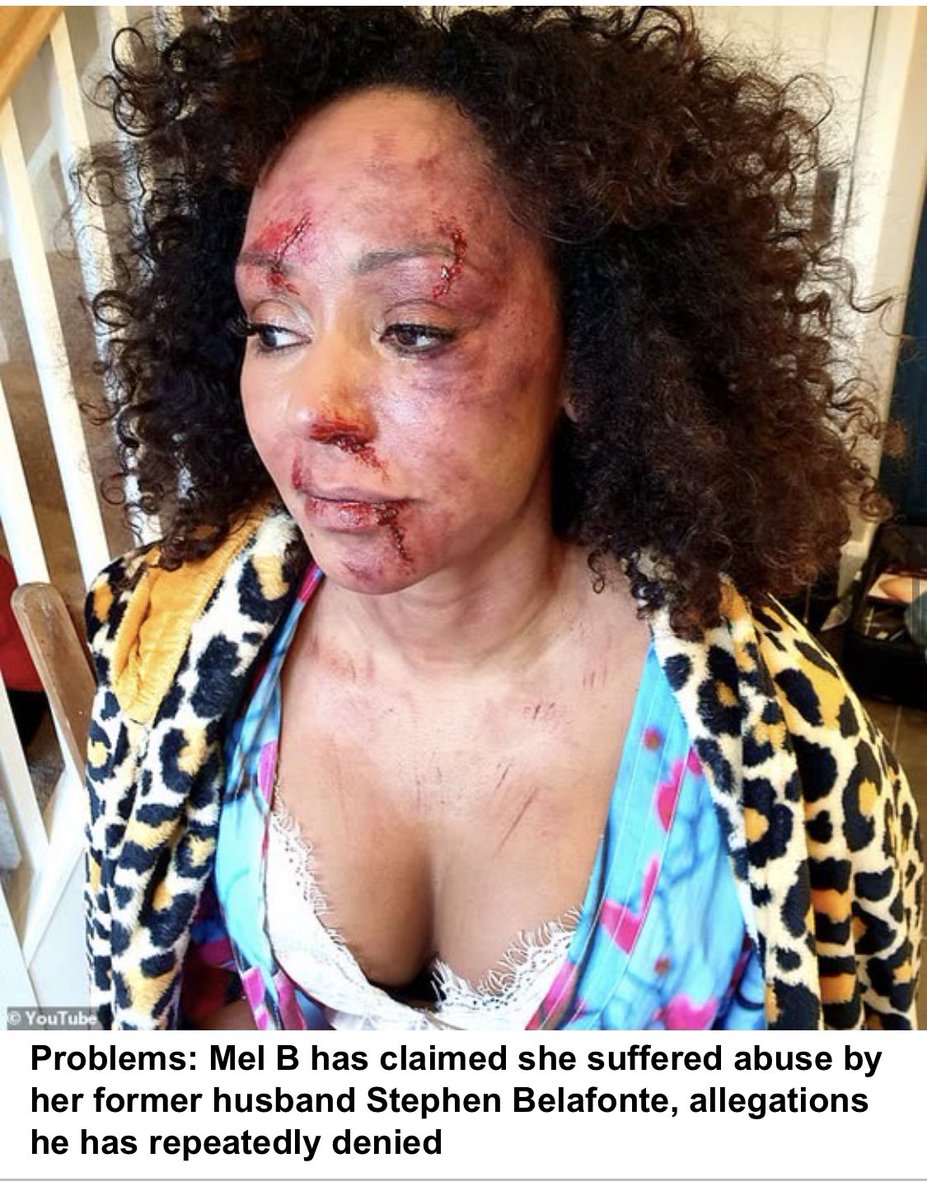 #JusticeForJohnnyDepp this is abuse by a partner. None of this was on #AmberHeard #AmberHeardIsALiar sad bc real victims have experience what she described.Bruises can happen but she had none or swelling  #IStandWithJohnnyDepp #JohnnyDeppVsAmberHeardTrial #Rihanna #MelB