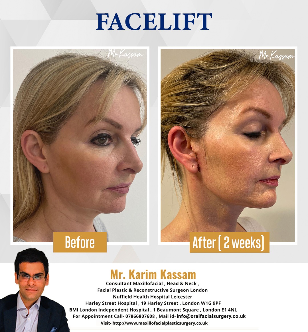 Amazing result of Facelift after just two weeks. 
Say hello to a youthful you! 

click here- maxillofacialplasticsurgery.co.uk

#DrKarimKassam 
#Plasticsurgeon
#facelift
#faceliftbeforeandafter