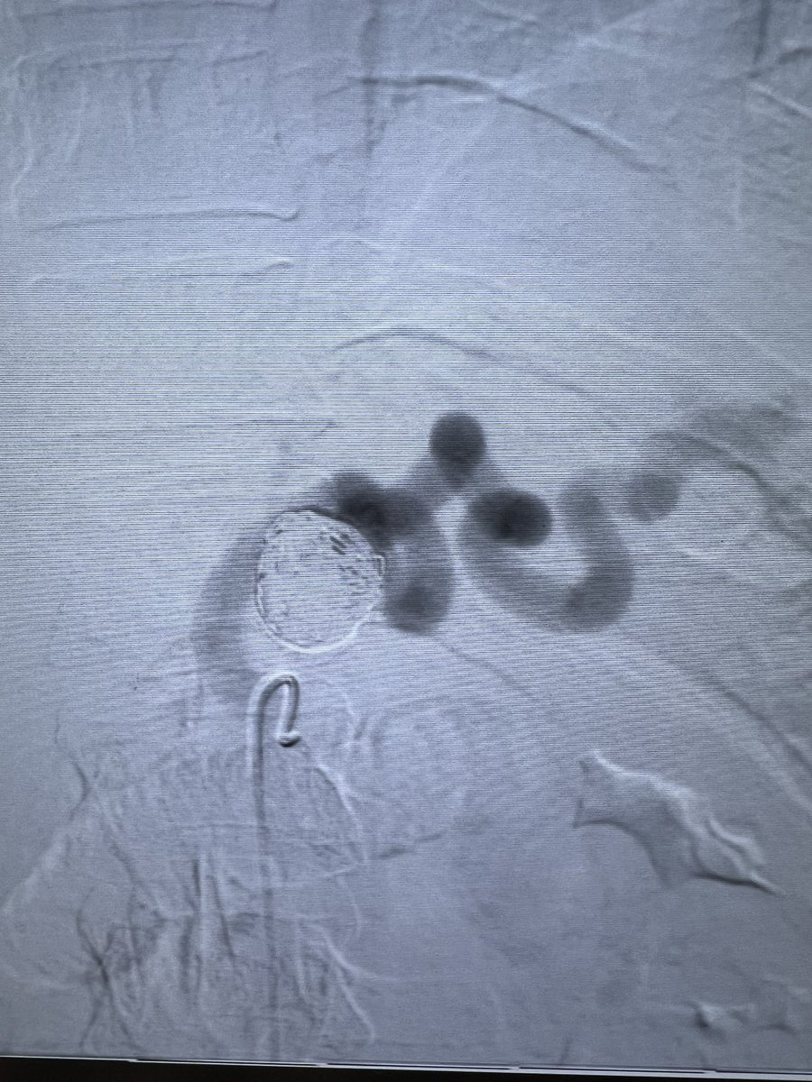 ChengaziMD's tweet photo. Incidental 2.5cm splenic aneurysm in w/u for LUQ pain. Quick and super satisfying embo with @PenVascular RUBY coils. @SIR_ECS @_backtable @SIRRFS @SIRspecialists #irad #vascular #WithoutAScalpel @ https://t.co/rwICq2W5fE