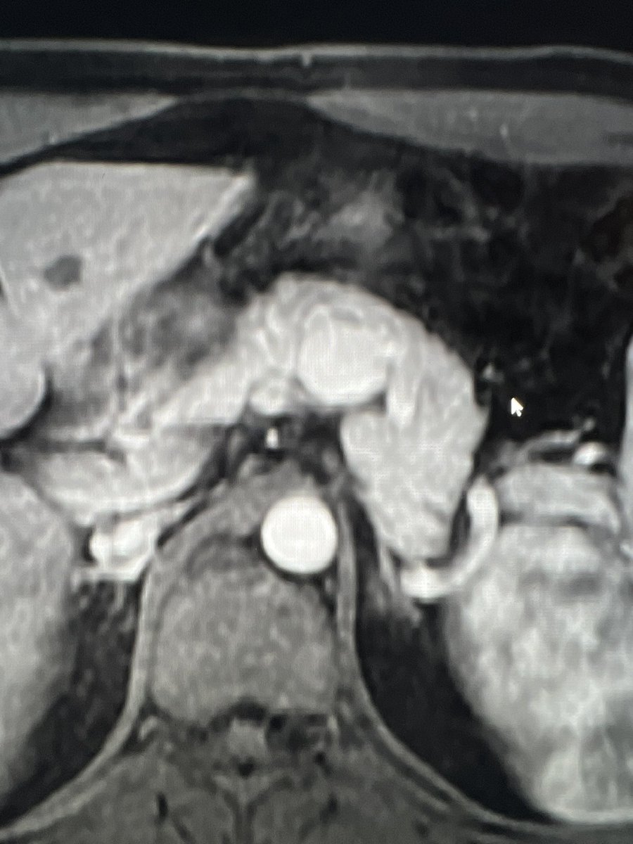 ChengaziMD's tweet photo. Incidental 2.5cm splenic aneurysm in w/u for LUQ pain. Quick and super satisfying embo with @PenVascular RUBY coils. @SIR_ECS @_backtable @SIRRFS @SIRspecialists #irad #vascular #WithoutAScalpel @ https://t.co/rwICq2W5fE