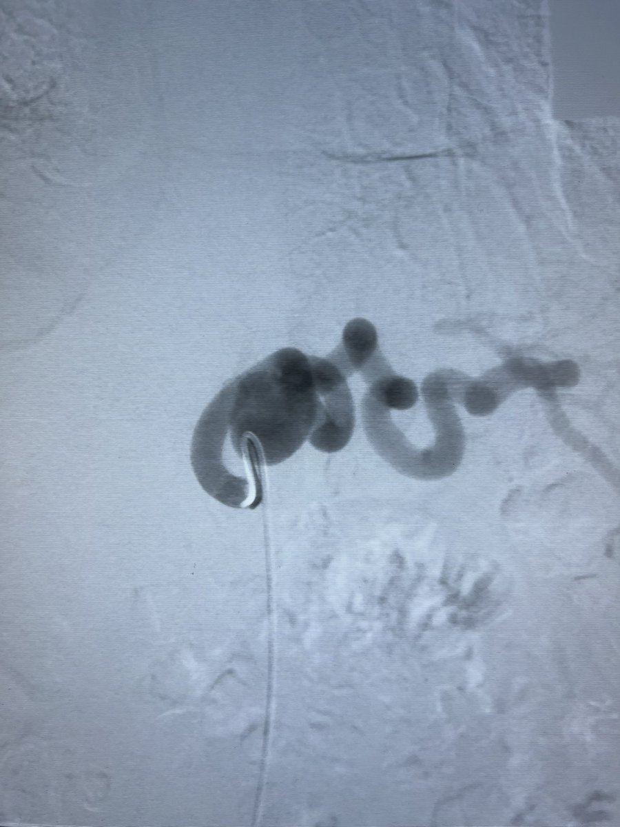 ChengaziMD's tweet photo. Incidental 2.5cm splenic aneurysm in w/u for LUQ pain. Quick and super satisfying embo with @PenVascular RUBY coils. @SIR_ECS @_backtable @SIRRFS @SIRspecialists #irad #vascular #WithoutAScalpel @ https://t.co/rwICq2W5fE