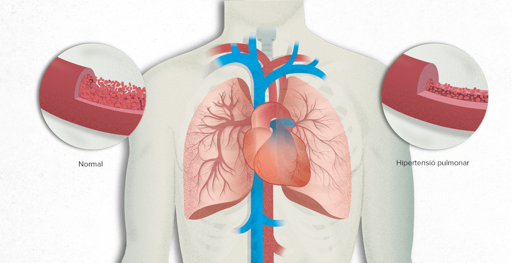 hospitalclinic's tweet photo. 📅 Hoy es el Día Mundial de la Hipertensión Pulmonar

Es el incremento anómalo de la presión de la sangre en las arterias pulmonares y puede producirse por enfermedades cardíacas y respiratorias crónicas.

➕ Info en #PortalCLÍNIC 👉 https://t.co/y7gYQ7qDN0 @fundacionBBVA https://t.co/DpZvb7XTrY