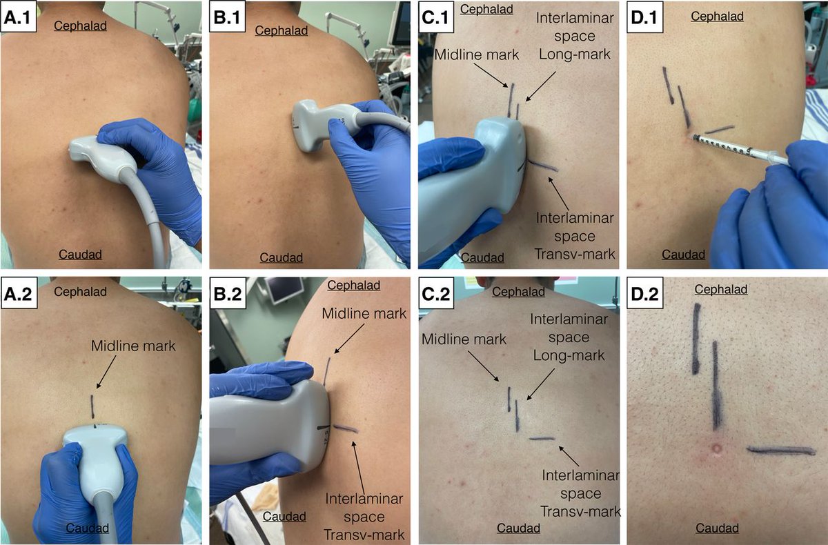 Comparison of ultrasound assistance versus traditional palpation method for placement of thoracic epidural catheters: a randomized controlled trial

bit.ly/3vnQmNF

#anesthesia #regionalanesthesia #regionalpain #POCUS #painmedicine
<a href="/dr_rajgupta/">Raj Gupta, MD, FASRA</a> <a href="/ESchwenkMD/">Eric Schwenk, M.D., FASA</a>