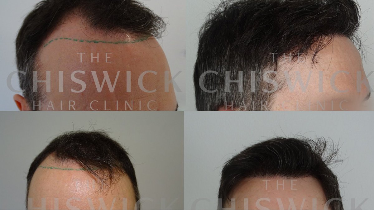 ChiswickHair's tweet photo. Before and After photos are a great way to show what a professionally done FUE procedure can do for looks.
Here is an example of 1790 grafts. https://t.co/O1VSAHrLz1