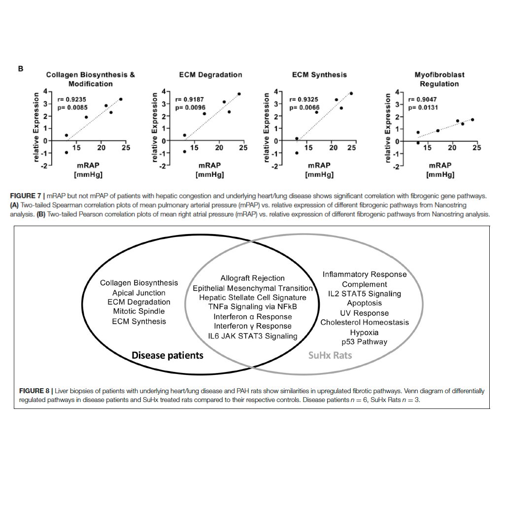 Georg Hansmann Lab (@hansmann_lab) on Twitter photo NEW PAPER OUT:Hamberger F et al. Frontiers Cardiovasc Med, 2022. frontiersin.org/articles/10.33…
Fibrogenic signature in patients with hepatic congestion due to heart disease: PAH patients should be screened for unrecognized liver fibrosis. #WorldPHDay,#hepatology, <a href="/3CPRCouncil/">3CPR Council</a>, <a href="/ATS_PC/">ATS PC Assembly</a> NEW PAPER OUT:Hamberger F et al. Frontiers Cardiovasc Med, 2022. frontiersin.org/articles/10.33…
Fibrogenic signature in patients with hepatic congestion due to heart disease: PAH patients should be screened for unrecognized liver fibrosis. #WorldPHDay,#hepatology, <a href="/3CPRCouncil/">3CPR Council</a>, <a href="/ATS_PC/">ATS PC Assembly</a>