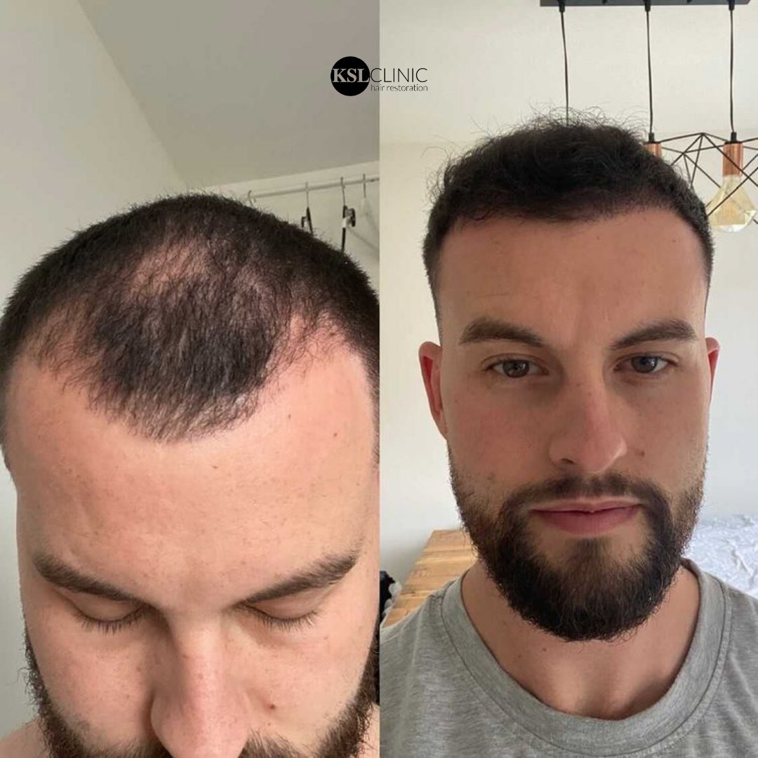 KSL Clinics | Hair Transplant Experts on Twitter: KSL Clinics | Hair Transplant Experts on Twitter: