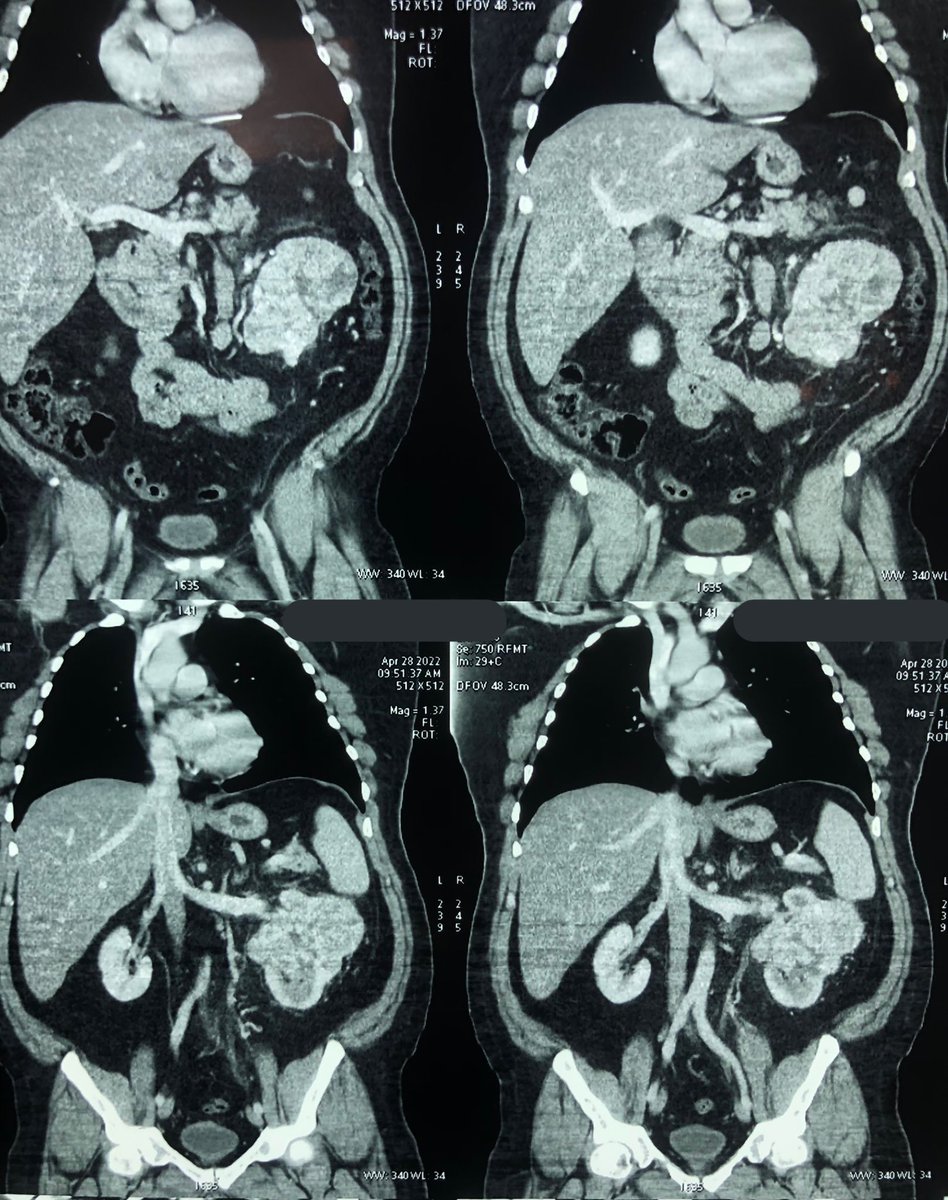 Resección laparoscópica de tumor de riñón, con peso mayor a los 1200 gramos 
<a href="/Urologos_UMANO/">Grupo Médico UMANO</a> en <a href="/CIMAHMO/">Hospital CIMA HMO</a> 
#Cancer #kidney #UroSoMe