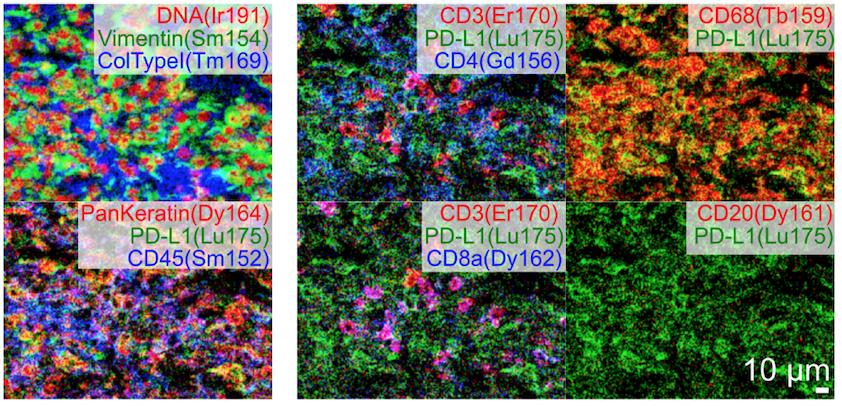 Congrats to <a href="/WCMEnglanderIPM/">WCM Englander Institute for Precision Medicine</a>'s <a href="/Hiranmayi_Ravi/">Hiranmayi Ravichandran</a> on "Tumor-immune microenvironment revealed by Imaging Mass Cytometry in metastatic sarcomatoid urothelial carcinoma," in <a href="/molcasestud/">CSH Molecular Case Studies</a> with @afrendeiro @JyothiManohar23 <a href="/FaltasLab/">Dr. Bishoy M. Faltas</a> <a href="/cnsternberg/">Cora Sternberg</a> <a href="/ElementoLab/">Olivier Elemento</a> etc

molecularcasestudies.cshlp.org/content/8/3/a0…