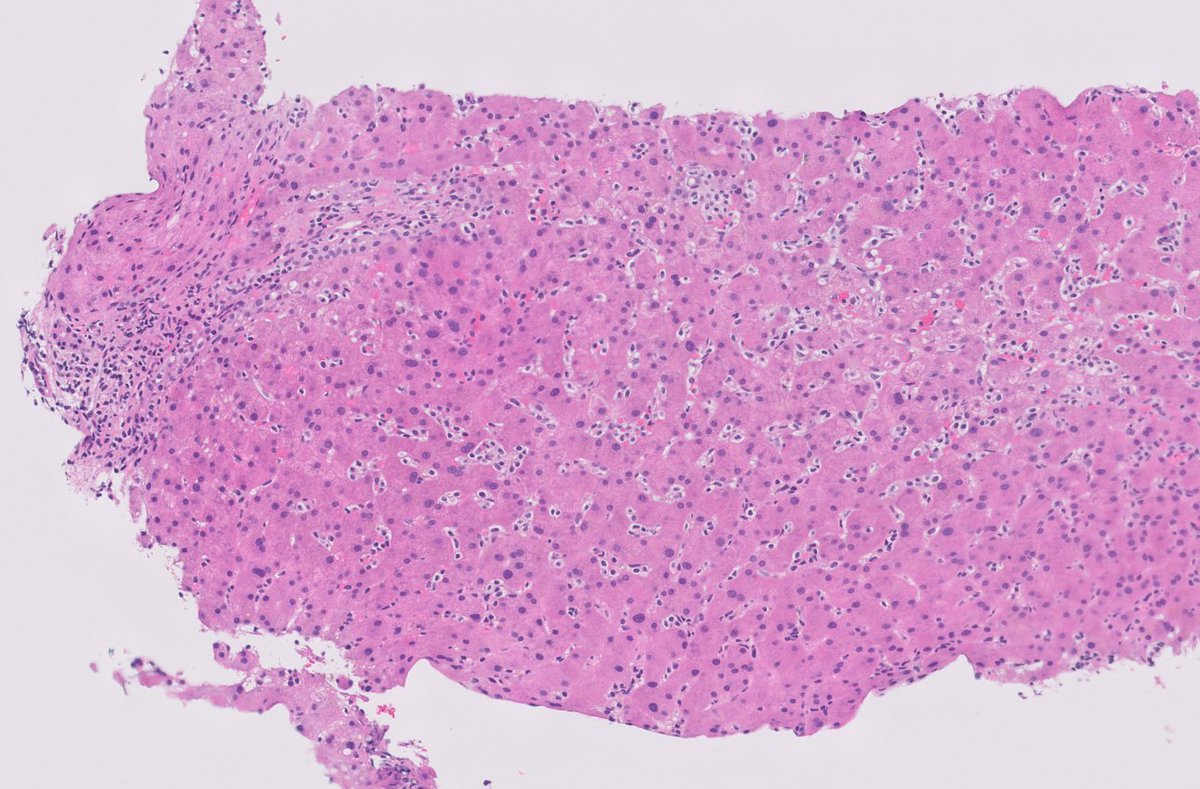 baking_md's tweet photo. Native liver biopsy: Guess the patient's history
#pathology #liverpathology #caseoftheday https://t.co/kf8T8FDnjc