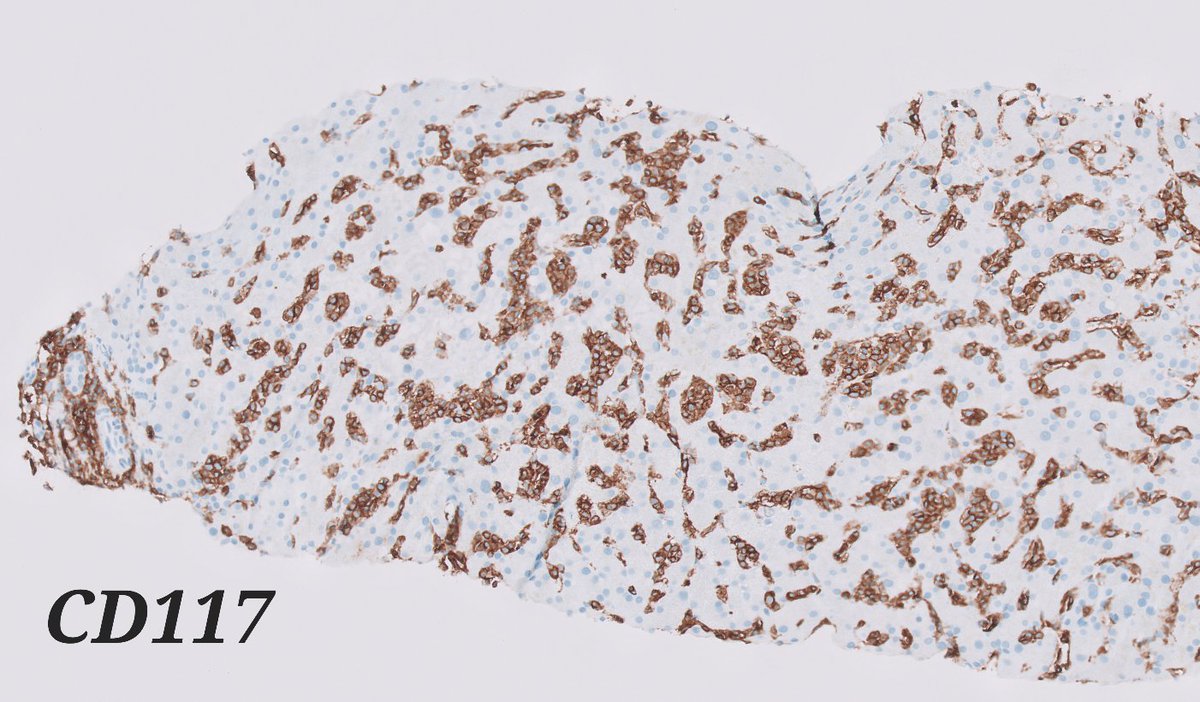 baking_md's tweet photo. Native liver biopsy: Guess the patient's history
#pathology #liverpathology #caseoftheday https://t.co/kf8T8FDnjc