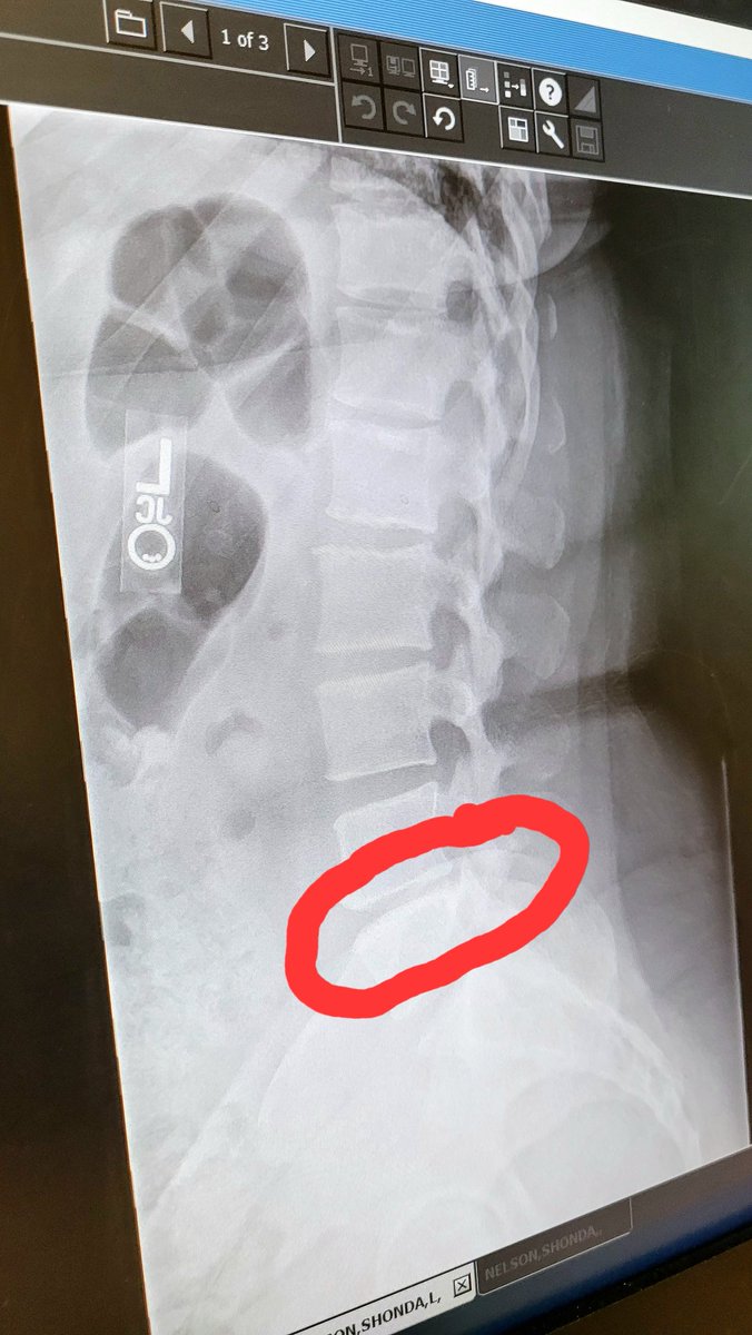 🎶Alright now stop.... it's fusion time🎶 I will be having my spinal fusion surgery soon and hope recovery will go quickly so I can get back to the streaming grind 😁😁