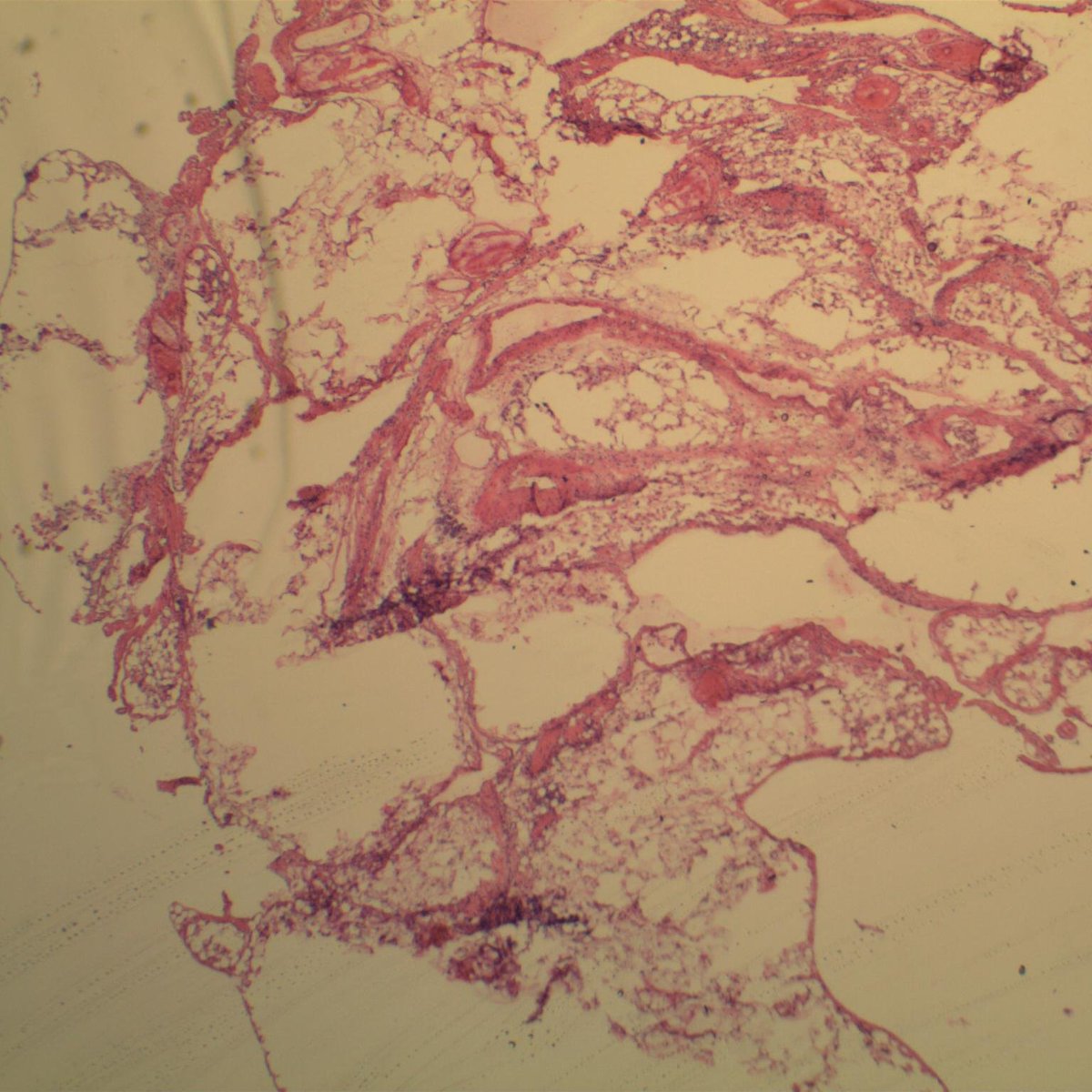 EKoubaMD's tweet photo. Frozen section, thickened omentum h/o gastric carcinoma. Interseptal adipose spread of diffuse type adenocarcinoma. Frozen and corresponding permanent slides shown #GIpath #frozenpath #pathology https://t.co/zR6iqfWgm6