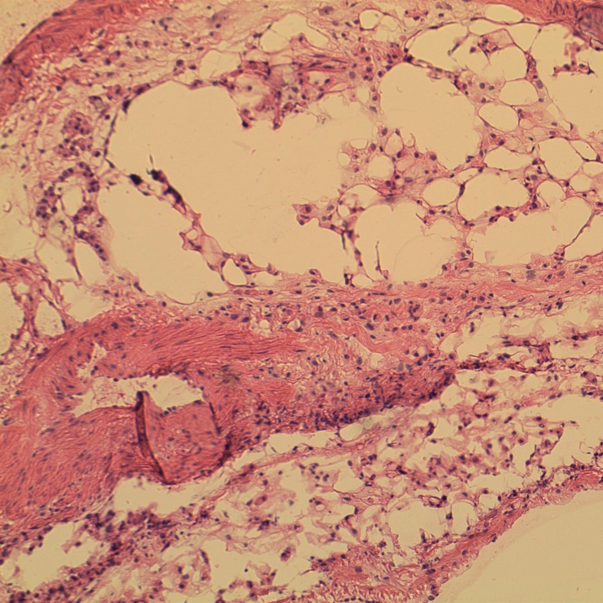 EKoubaMD's tweet photo. Frozen section, thickened omentum h/o gastric carcinoma. Interseptal adipose spread of diffuse type adenocarcinoma. Frozen and corresponding permanent slides shown #GIpath #frozenpath #pathology https://t.co/zR6iqfWgm6