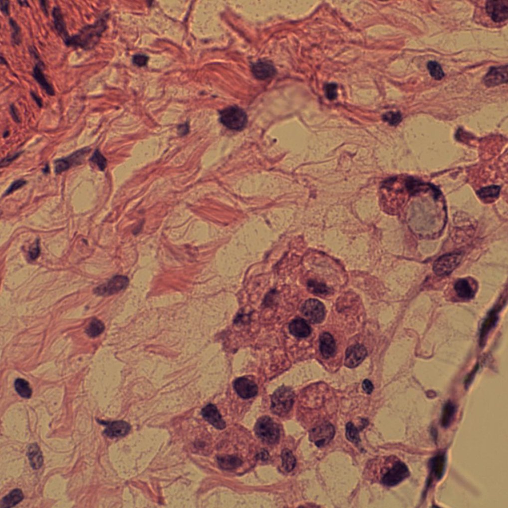 EKoubaMD's tweet photo. Frozen section, thickened omentum h/o gastric carcinoma. Interseptal adipose spread of diffuse type adenocarcinoma. Frozen and corresponding permanent slides shown #GIpath #frozenpath #pathology https://t.co/zR6iqfWgm6