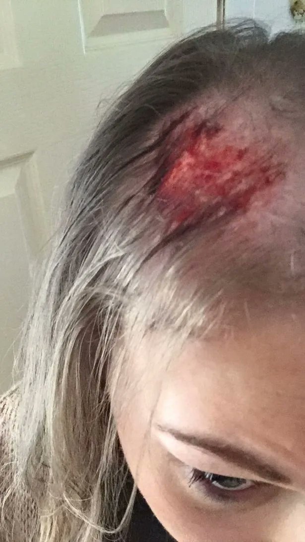 EvelynAsche's tweet photo. This is what a scalp looks like after hair has been ripped out.
#AmberHeardlsALiar https://t.co/372vpdDG5B