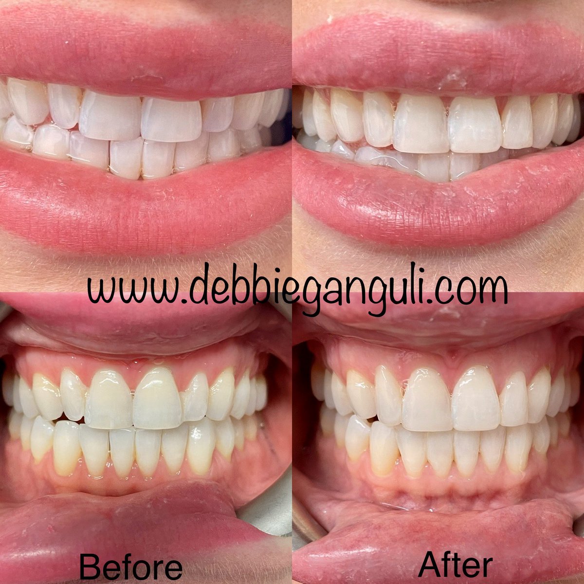 Subtle changes to this lovely smile using <a href="/BoutiqueWhiten/">Boutique Whitening</a> and composite restorations