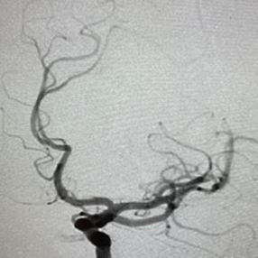 PenNeuro's tweet image. US HCPs: Dr. Mohamed Teleb (@StrokeVAN) used #RED62 for revascularization in this case out of Banner Desert Medical Center. #REDglideDifference #StrokeAwarenessMonth Rx only. For risk info: bit.ly/37YcYIU. Clinical results may vary.