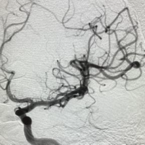 PenNeuro's tweet image. US HCPs: Dr. Mohamed Teleb (@StrokeVAN) used #RED62 for revascularization in this case out of Banner Desert Medical Center. #REDglideDifference #StrokeAwarenessMonth Rx only. For risk info: bit.ly/37YcYIU. Clinical results may vary.