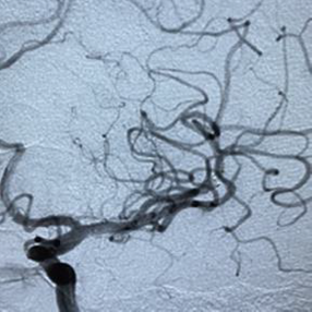 PenNeuro's tweet image. US HCPs: Dr. Mohamed Teleb (@StrokeVAN) used #RED62 for revascularization in this case out of Banner Desert Medical Center. #REDglideDifference #StrokeAwarenessMonth Rx only. For risk info: bit.ly/37YcYIU. Clinical results may vary.