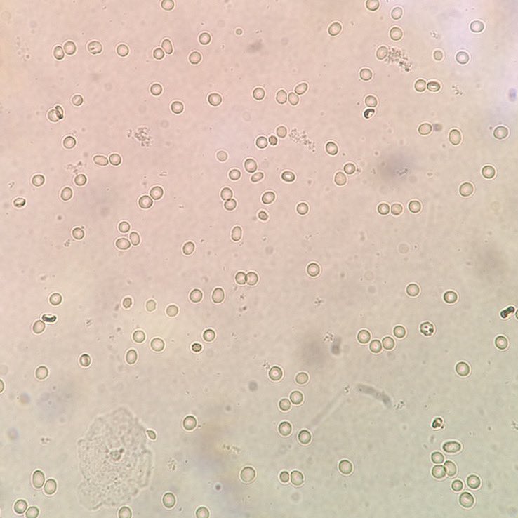 hcbinns's tweet image. Little did I know 6 years ago when I was spending my days counting cells in clinical samples (urine with presence of RBCs shown in first pic) that I’d be looking at red blood cells like this now (second pic)😍🔬🩸#publicheath #clinicallabscience #hematology #phdlife #SEM #glowup