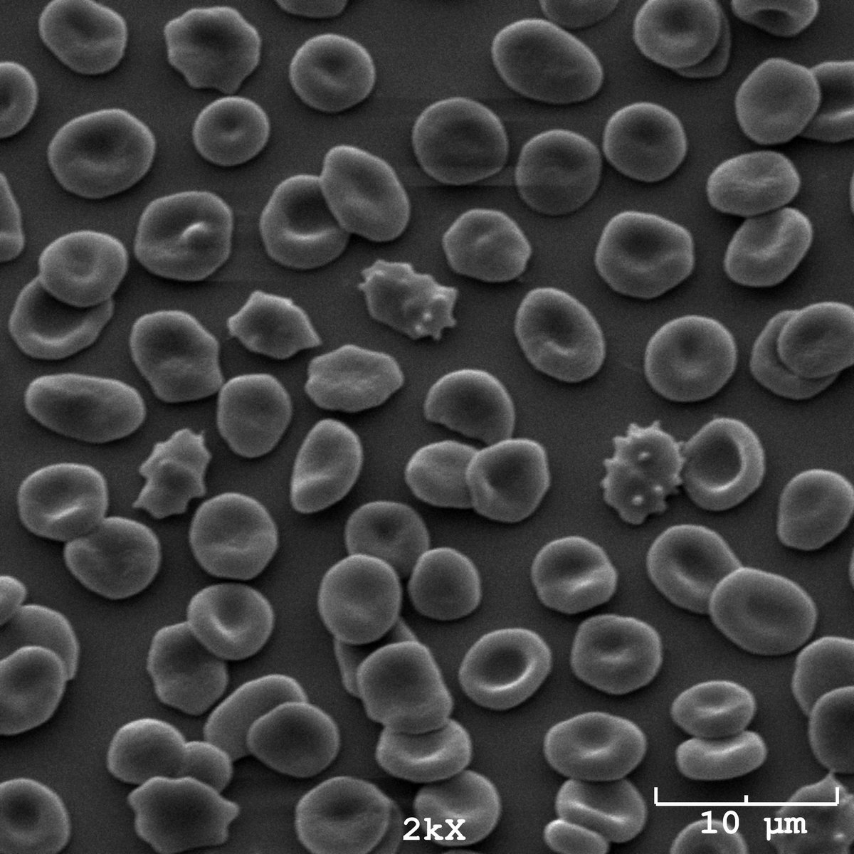 hcbinns's tweet image. Little did I know 6 years ago when I was spending my days counting cells in clinical samples (urine with presence of RBCs shown in first pic) that I’d be looking at red blood cells like this now (second pic)😍🔬🩸#publicheath #clinicallabscience #hematology #phdlife #SEM #glowup
