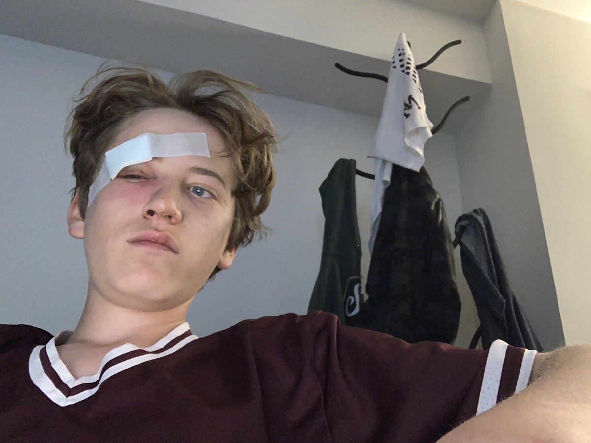 cooperwinter13's tweet photo. Now i know how it feels to get hit by a pitch straight to the face. 20+ stitches. 👍 https://t.co/XFvV9pPU4g