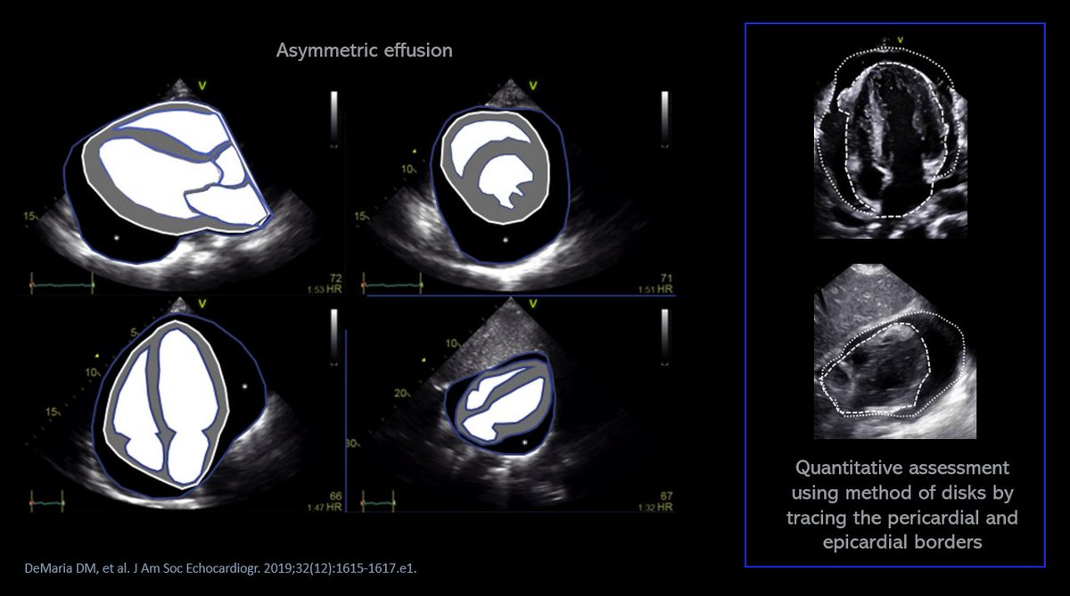 NephroP's tweet photo. Size of pericardial effusion on #echofirst is generally graded as small (<1 cm), moderate (1-2 cm), or large (>2 cm), which becomes a little ambiguous in case of asymmetric effusions.
This paper explores a quantitative method🔗 https://t.co/T4HAREtUFw 
(🤔#POCUS relevance)
#MedEd https://t.co/AirLT6SfA2