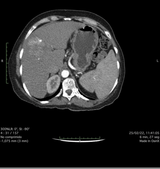 MicrowaveEco's tweet photo. #casesharing
ECO MICROWAVE TUMOR ABLATION 
CIUDAD DE MEXICO ABRIL 2022 
HOSPITAL SAN ANGEL INN DR. @JoelMaldonado RADIOLOGIA INTERVENCIONISTA 

#ecomicrowave #hospital #health #ablation #liver #tumor #mwa https://t.co/q0YeXkTVz5