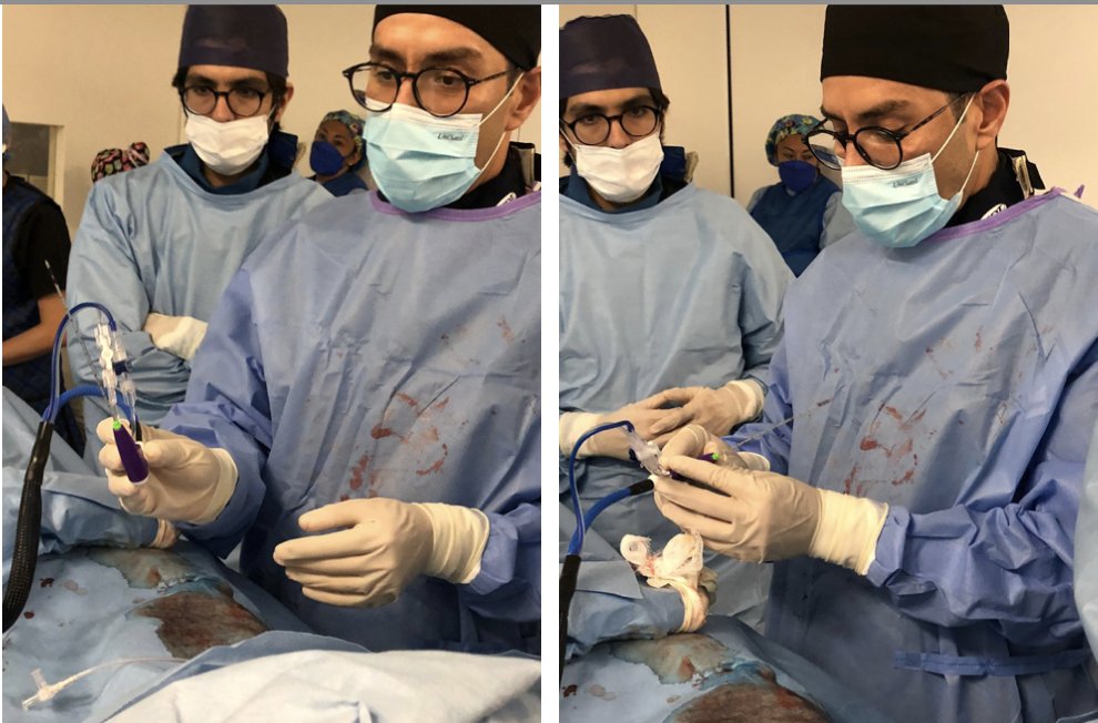 MicrowaveEco's tweet photo. #casesharing
ECO MICROWAVE TUMOR ABLATION 
CIUDAD DE MEXICO ABRIL 2022 
HOSPITAL SAN ANGEL INN DR. @JoelMaldonado RADIOLOGIA INTERVENCIONISTA 

#ecomicrowave #hospital #health #ablation #liver #tumor #mwa https://t.co/q0YeXkTVz5