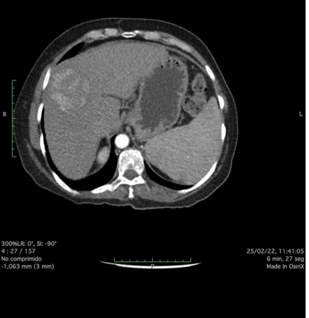 MicrowaveEco's tweet photo. #casesharing
ECO MICROWAVE TUMOR ABLATION 
CIUDAD DE MEXICO ABRIL 2022 
HOSPITAL SAN ANGEL INN DR. @JoelMaldonado RADIOLOGIA INTERVENCIONISTA 

#ecomicrowave #hospital #health #ablation #liver #tumor #mwa https://t.co/q0YeXkTVz5