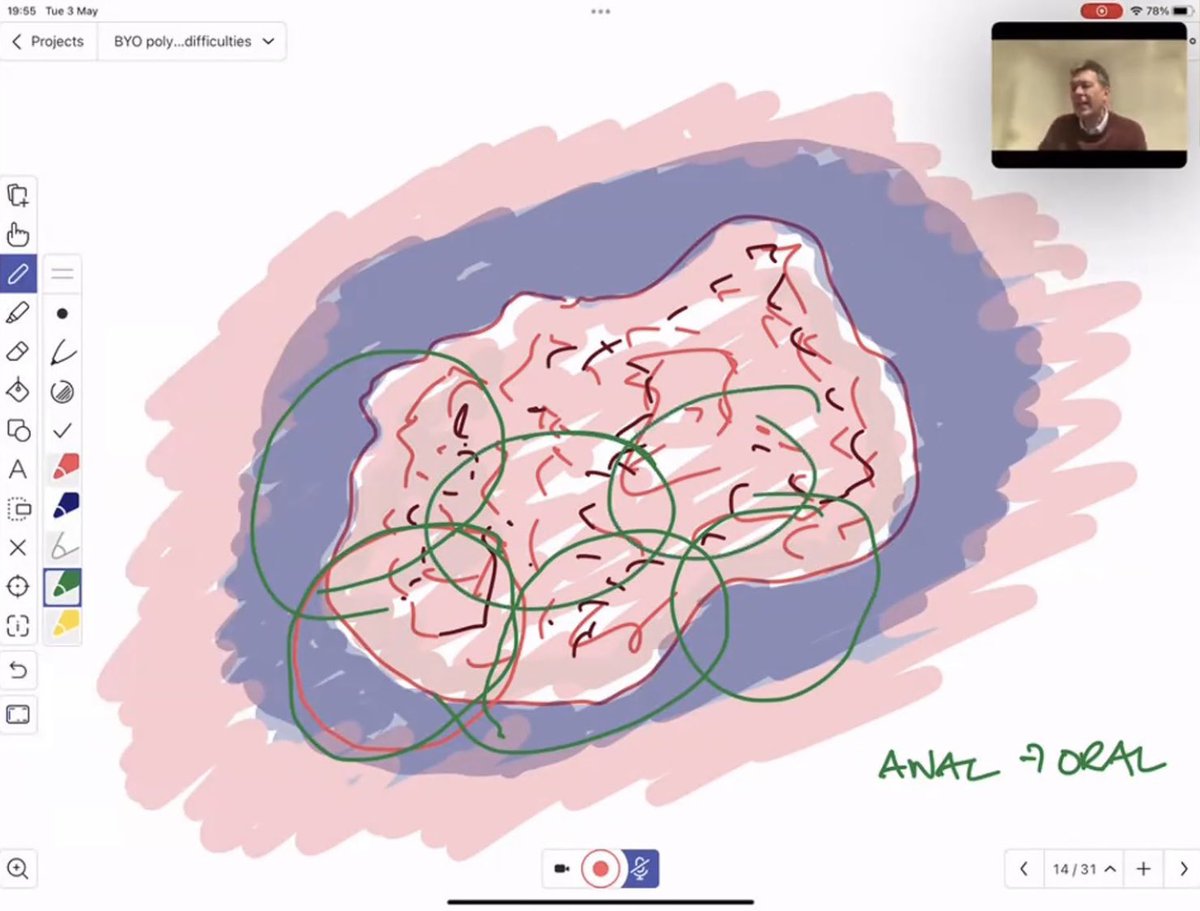 Webinar on Basic Polypectomy Theory now online. Chapters for quick access to knowledge. Tags soon. Here best outcomes in piecemeal resection 1️⃣ complete excision 2️⃣ meticulous snare placement. Watch at tinyurl.com/34ccerh9 #GITwitter