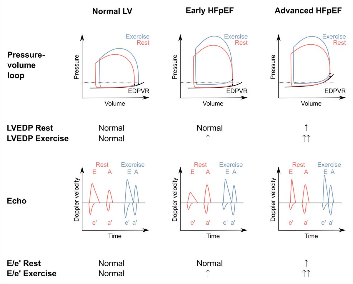 Heart_BMJ's tweet image. Heart failure with preserved ejection fraction: recent concepts in diagnosis, mechanisms and management bit.ly/3ozgb9z