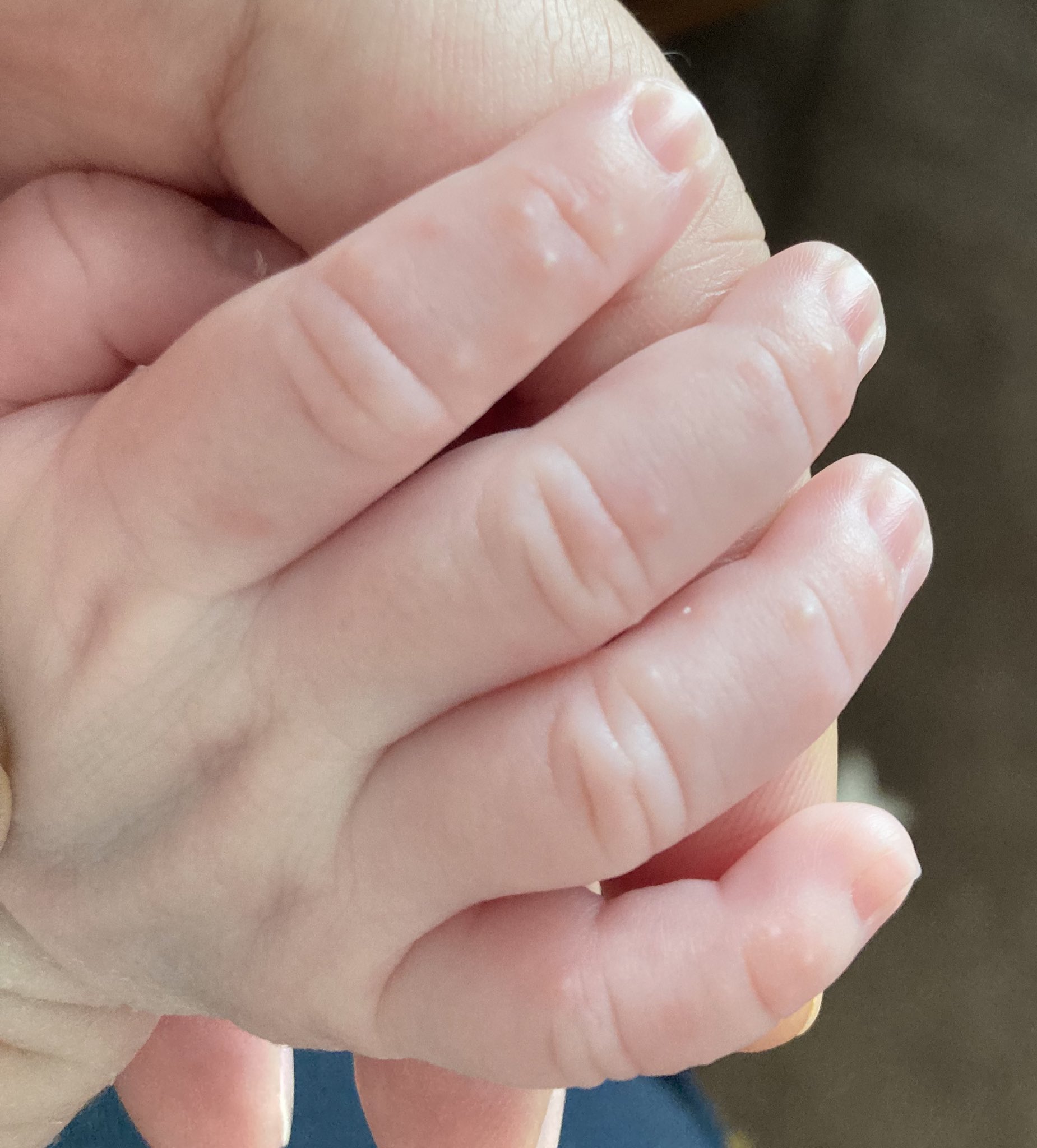 むぎっこ Pa Twitter この指のぷつぷつ 乳児湿疹ですか 新生児期だし 病院なんか特に控えたいし 皮膚科にかかるかどうか どうしたらいいか 先輩ママ様パパ様情報いただけたら ありがたやです T Co Wfsdtv6pet Twitter