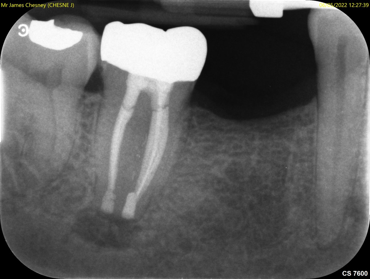 Intentional replantation can be a predictable and viable treatment option. In this case a long LR7 not suitable for root end surgery. No cracks visible under the microscope, MTA root end filling. First radiographic review in 1 month.🙃