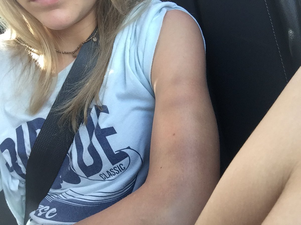 Jules27middie's tweet photo. Girls lacrosse is definitely a contact sport!  Got these at Sand Storm earlier this year 🖤💙🥍💙🖤#bruises #trophies #contactsport #loveit @USAWLax @USA_Lacrosse @LaxGirlProbs @officiallaxgirl https://t.co/a9V9RBdDWa