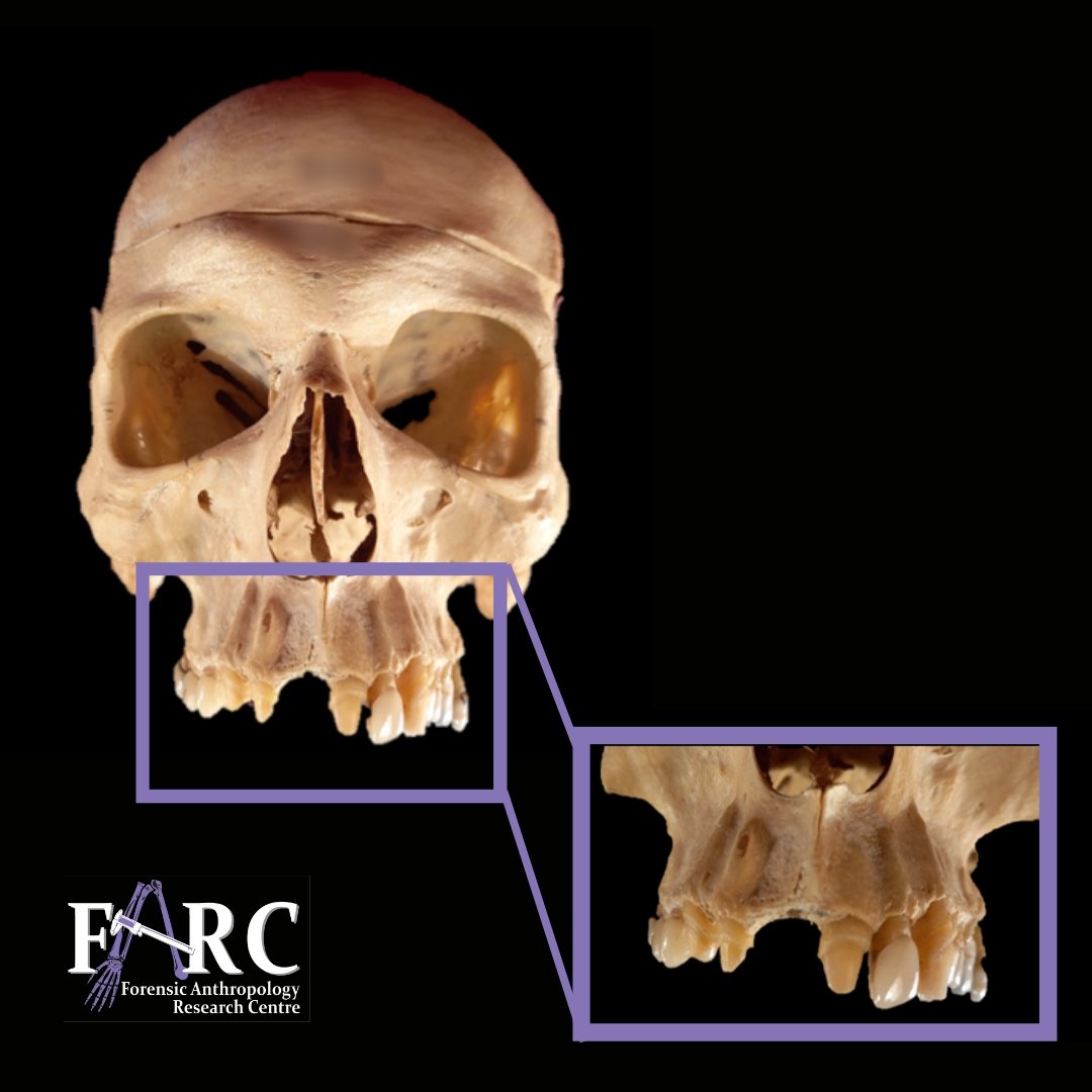 UPAnthro's tweet photo. #wtFARCfriday
If a single missing tooth isn't replaced with an implant, the adjacent teeth are often shaved down and used as anchors for a dental bridge - we expect that was the case for this individual 🦷🕵
#dentition #dentalbridge #humanosteology #teeth #lostatooth https://t.co/n11lMJlxFJ