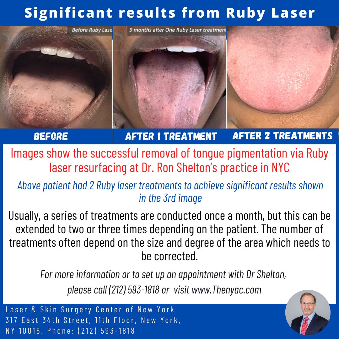 Black Lesions Tongue Hairy Tongue 